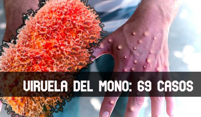 ContraPunto El Salvador - 70 casos de Viruela del Mono se aproximan. No actualizan datos Covid19